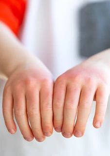 En pojke visar att han bränt sig på sina händer. Händerna är röda och torra. 