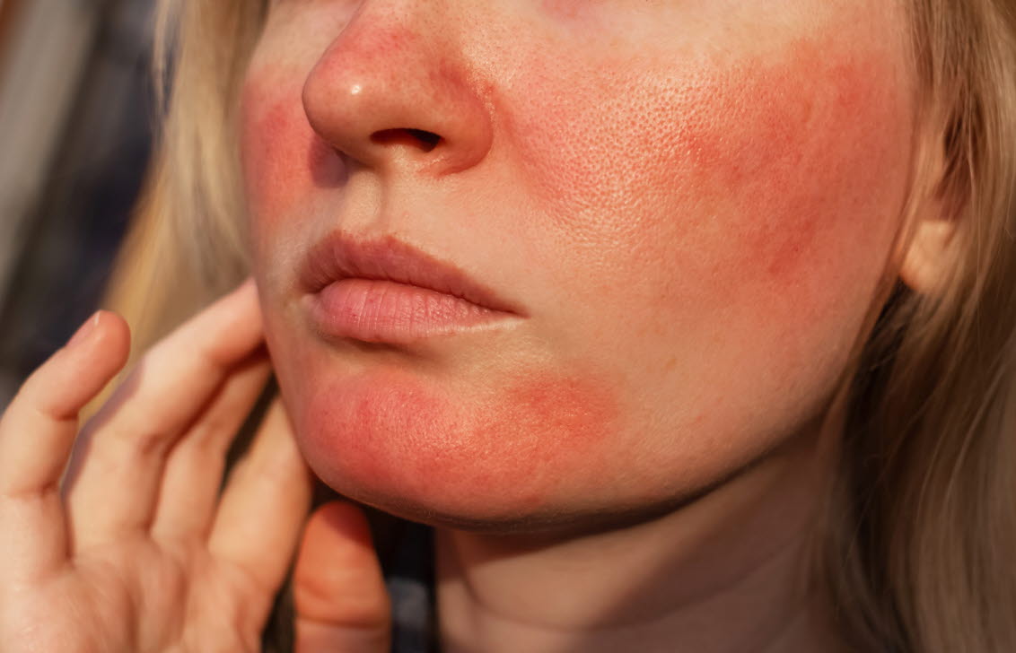Kvinna med utslag som kan bero på perioral dermatit eller rosacea.
