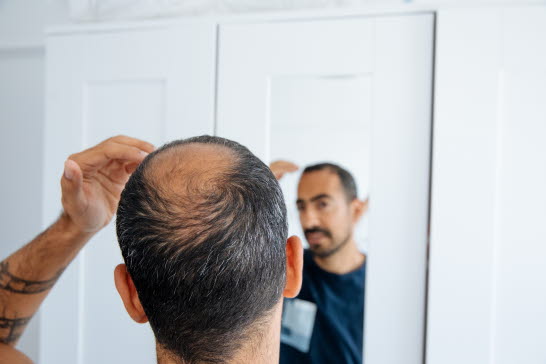 Man framför spegel med kal fläck på huvudet. Manligt håravfall är vanligt.