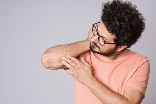 Psoriasis kan likna andra hudproblem, som eksem eller rosacea.