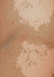 Arm med infektionen Pityriasis Versicolor. 