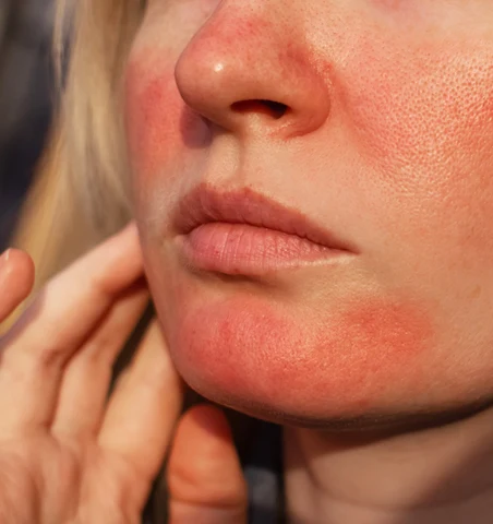 Kvinna med rosacea i ansiktet.